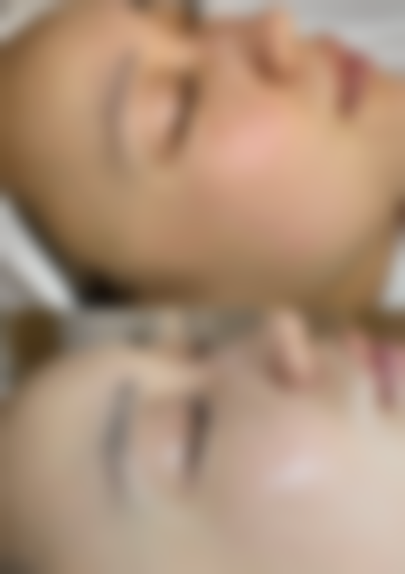 剥离法修复轻微凹陷性疤痕的方法