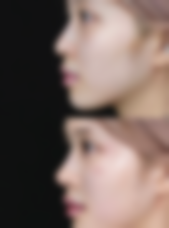 打瘦脸针时的注意事项