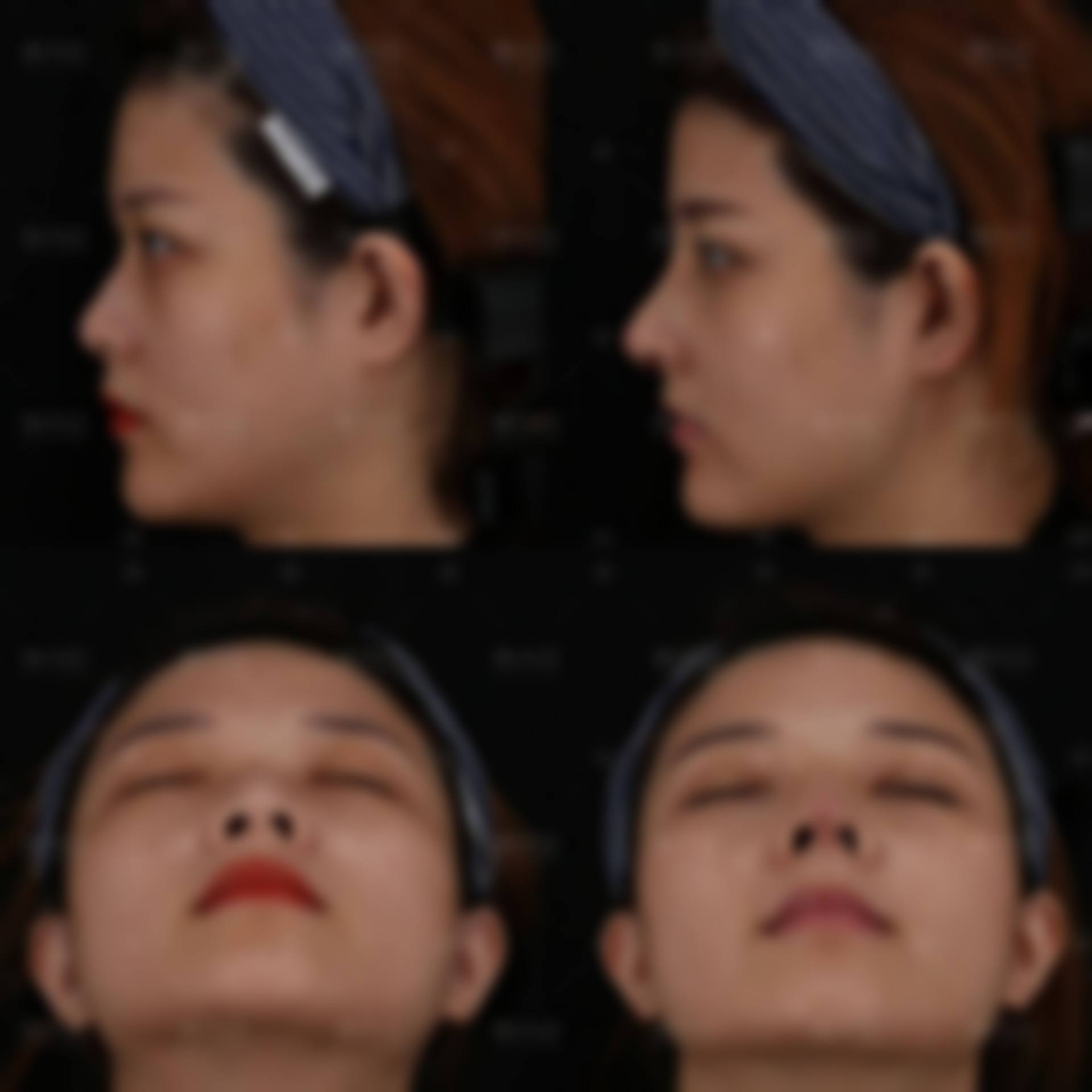 石家庄雅芳亚医疗美容医院吴小玉医生技术好不好？