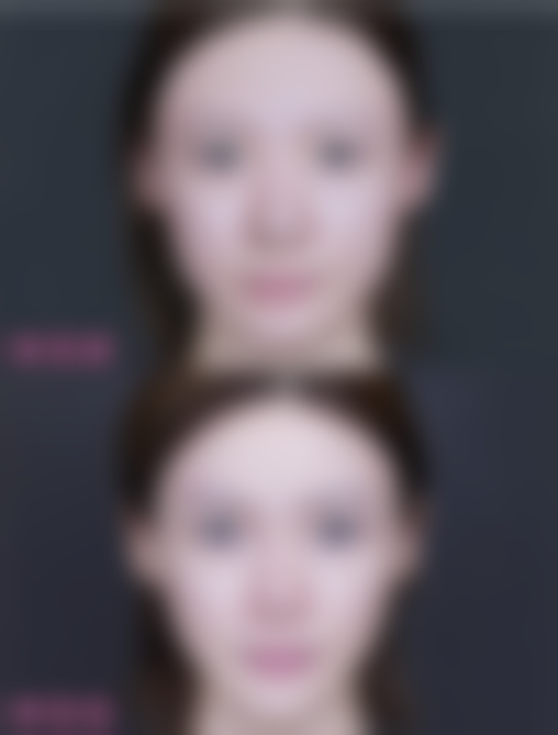 北京米兰柏羽丽都医美【眼周3C除皱】套餐还有其他补贴吗？