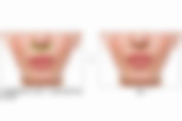 北京蕾士悦容医美科普：回颜臻45mg + 润百颜·玻玻2mL项目有什么优势？