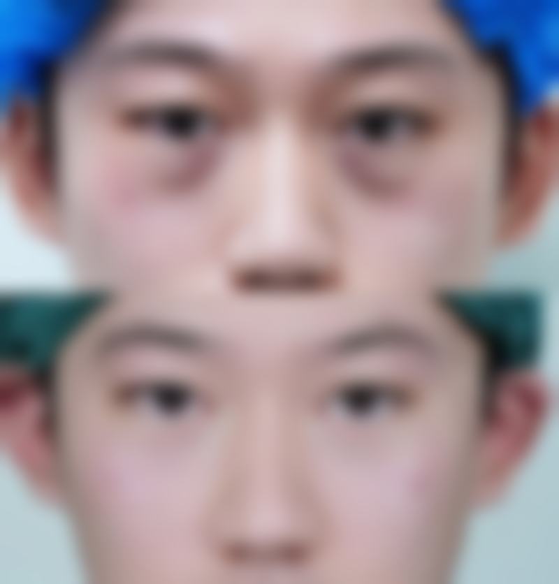 韩国365mc医院吴泰燮(新村兰斯院长)医生技术好不好?