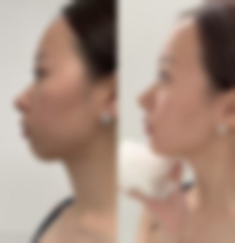 郑州第一人民医院整形科收费标准参考