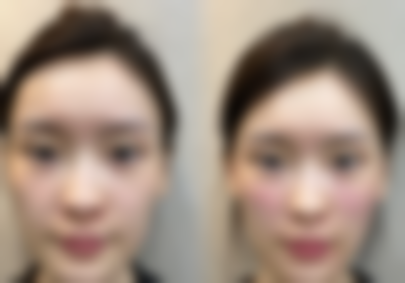 佛山医博士整形美容医院邓勤焕医生口碑评价如何？