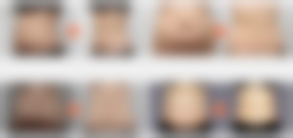 总结——韩国365mc吸脂医院徐熙媛（江南院）医生怎么样？