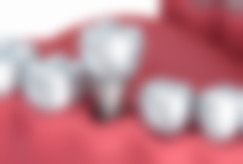 三、张先国医生在口腔领域技术特长