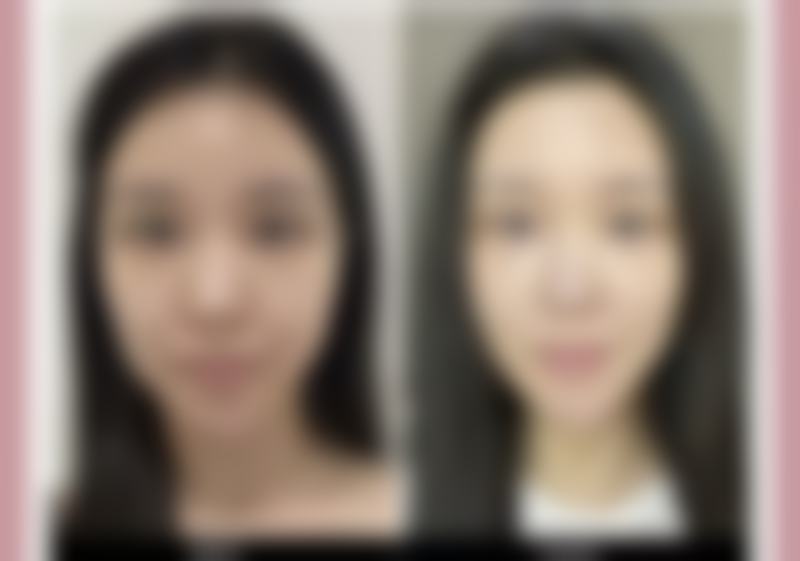 日常护理辅助去除手上缝针疤痕