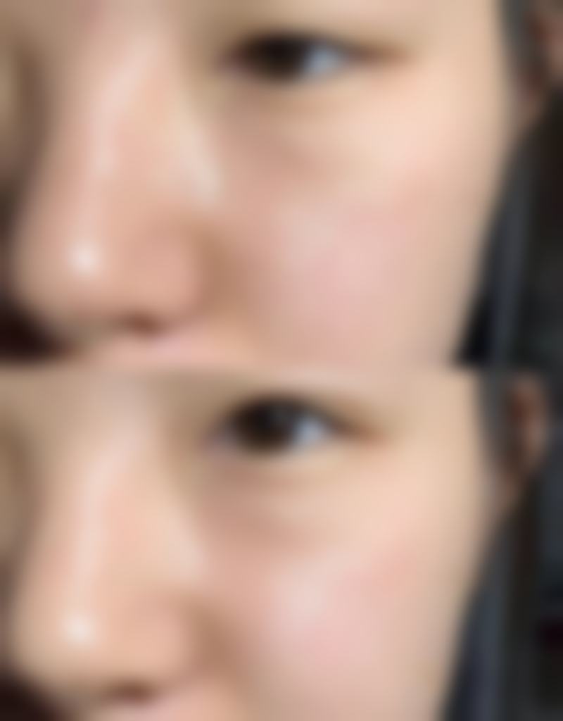 眼袋外眦固定手术的术后护理