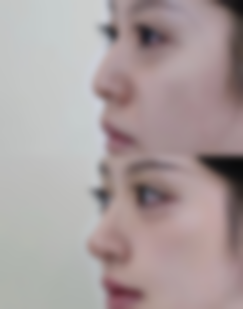 整形手术去除好几年的手术疤痕