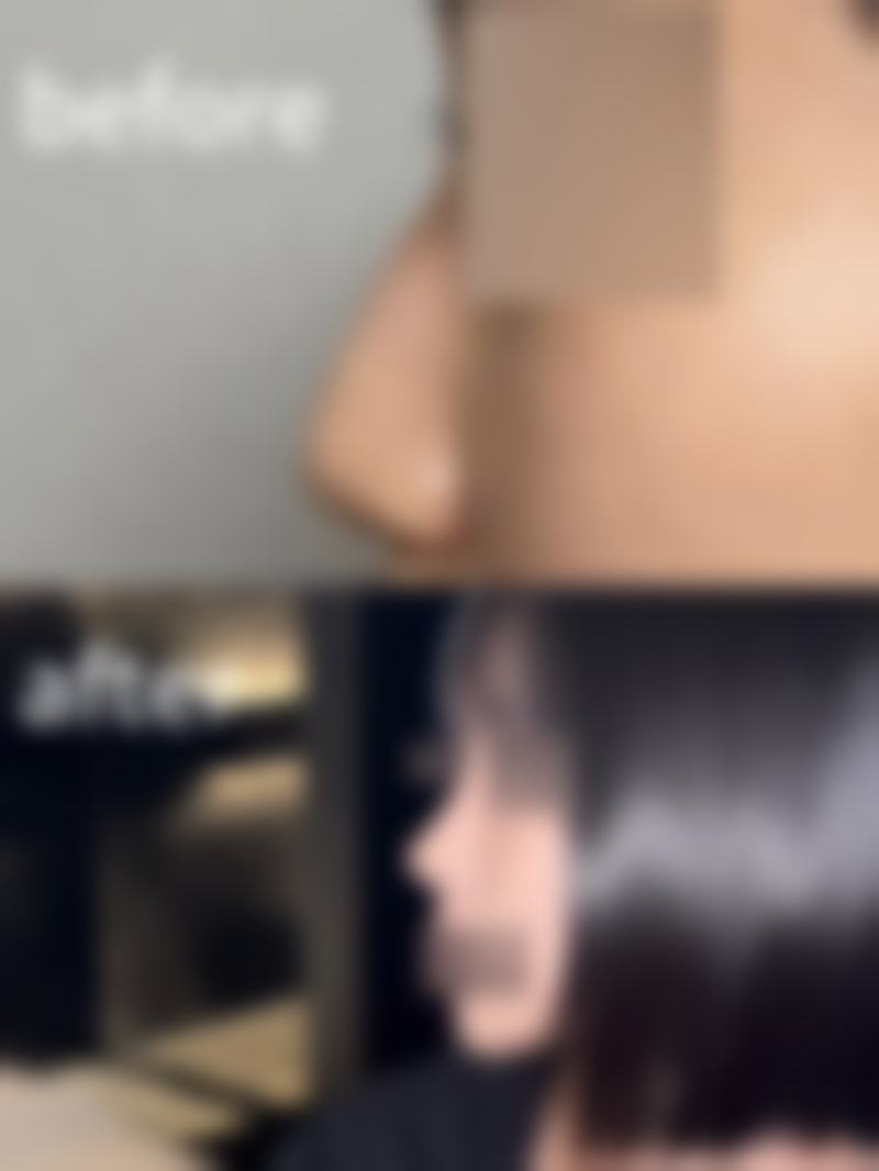 维生素E软胶囊对去痦子疤痕修复有啥作用