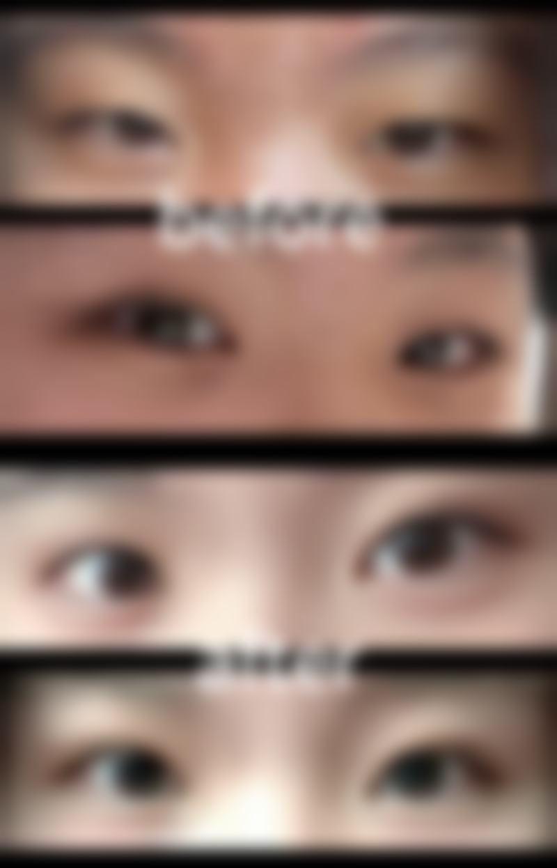 促进耳软骨隆鼻消肿的方法