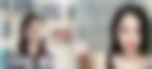 成都天使之翼医学美容医院成都天使之翼医疗美容吴开泉主任的韩 式隆鼻案例