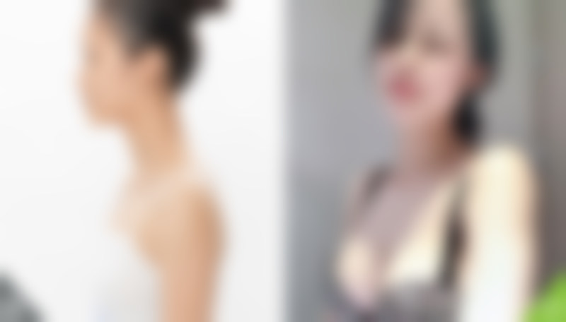 成都天使之翼医学美容医院成都天使之翼医疗美容丰胸案例分享