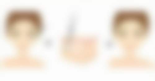 总结——广州建国医院私密整形科尹丽丽医生怎么样？