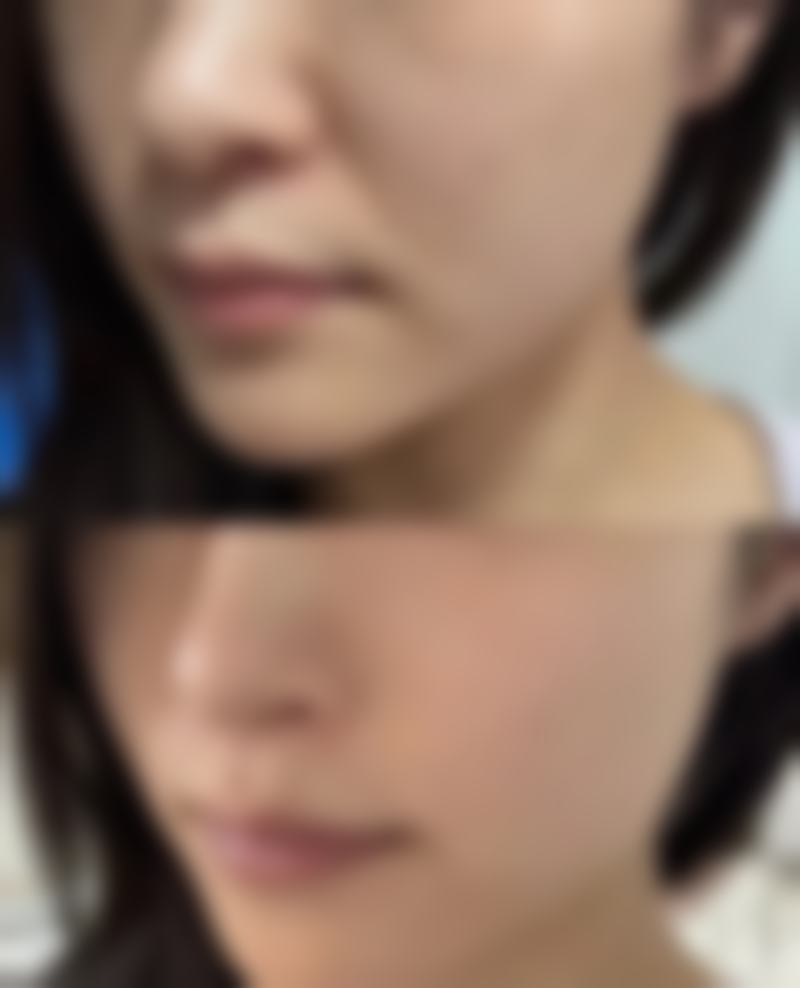 广州华美：郝永生抽脂性价比高