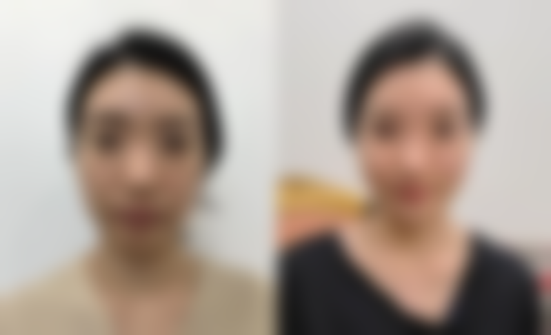 术后沾水洗脸的注意事项