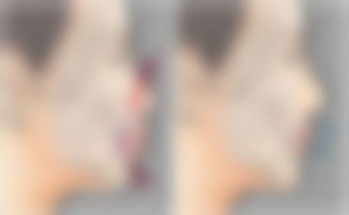 北京紫洁张学艳医生做不开刀双眼皮靠谱吗