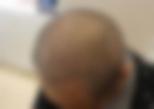 七、合肥新生植发医院价格表：（仅供参考）