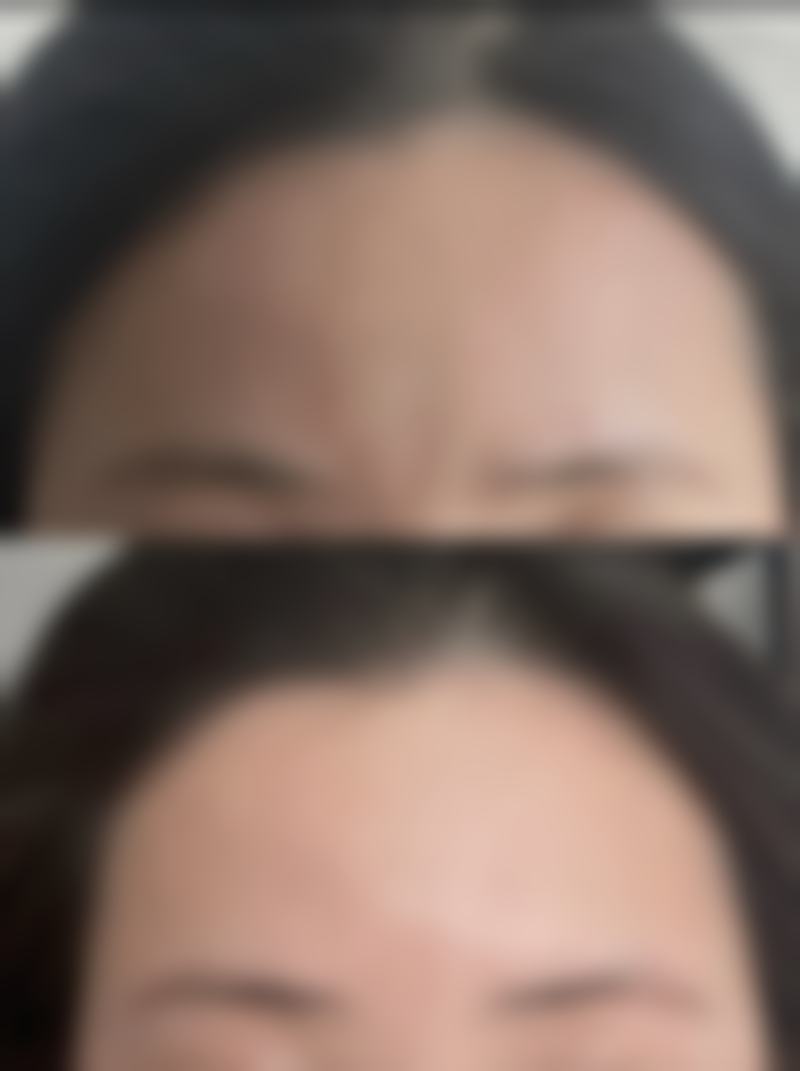 隆胸手术后拆线的过程是怎样进行的