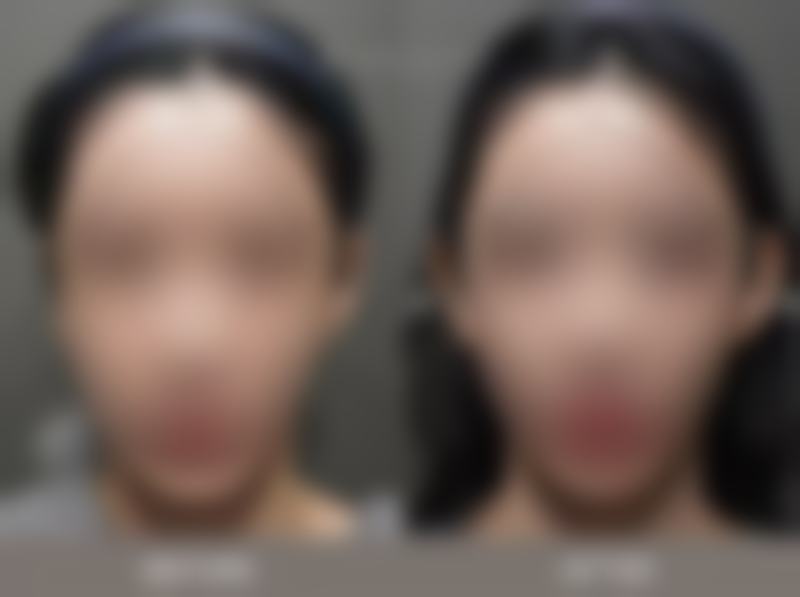 帅男眼贴对不同类型眼袋的成效