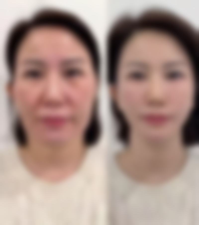 加速吸脂后消肿的方法