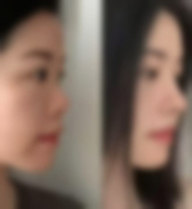 拆线后的注意事项有哪些