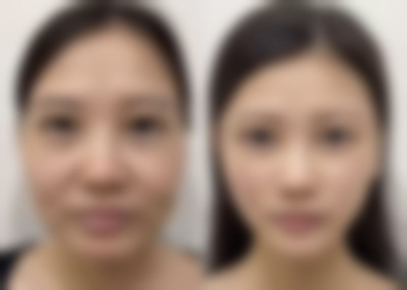 埋线双眼皮可能导致眼部形态不对称