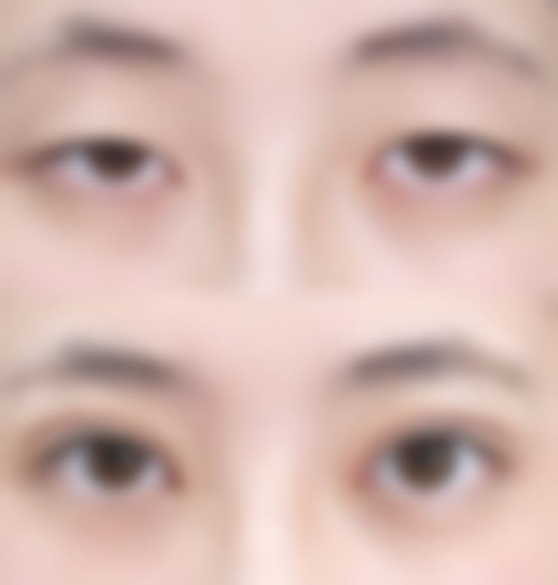 意大利优福通环激光治疗增生疤痕疙瘩