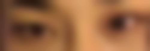 凹陷性疤痕的特点有哪些