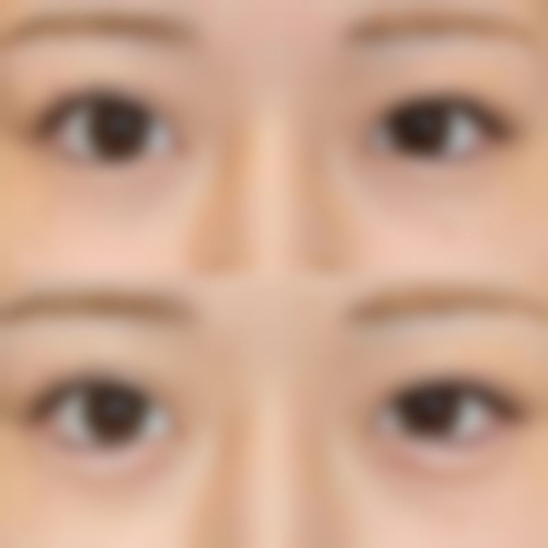 影响疤痕修复时间的因素