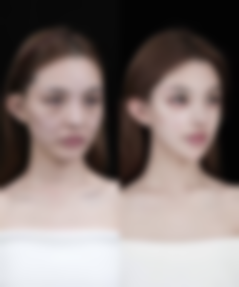 不同双眼皮手术方式第三天肿胀情况