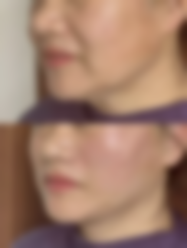 凹陷性疤痕能除吗的总结