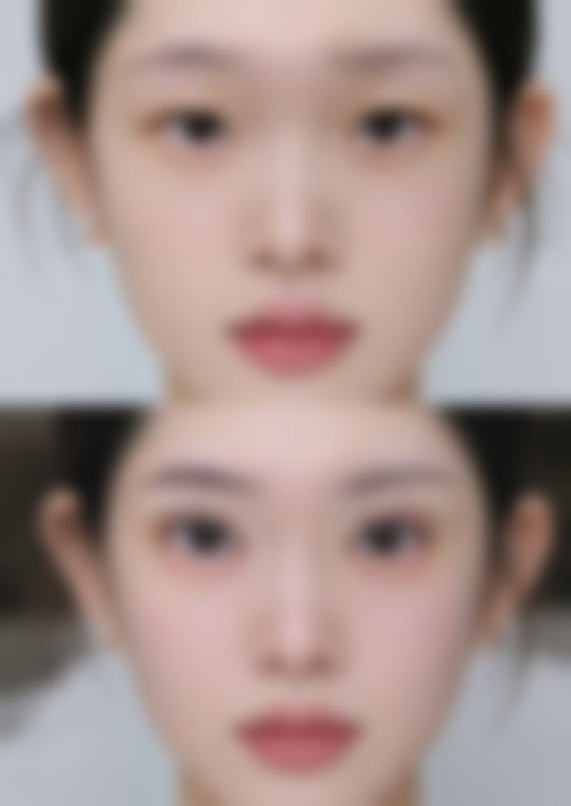 医美手段去除黑眼圈和眼袋