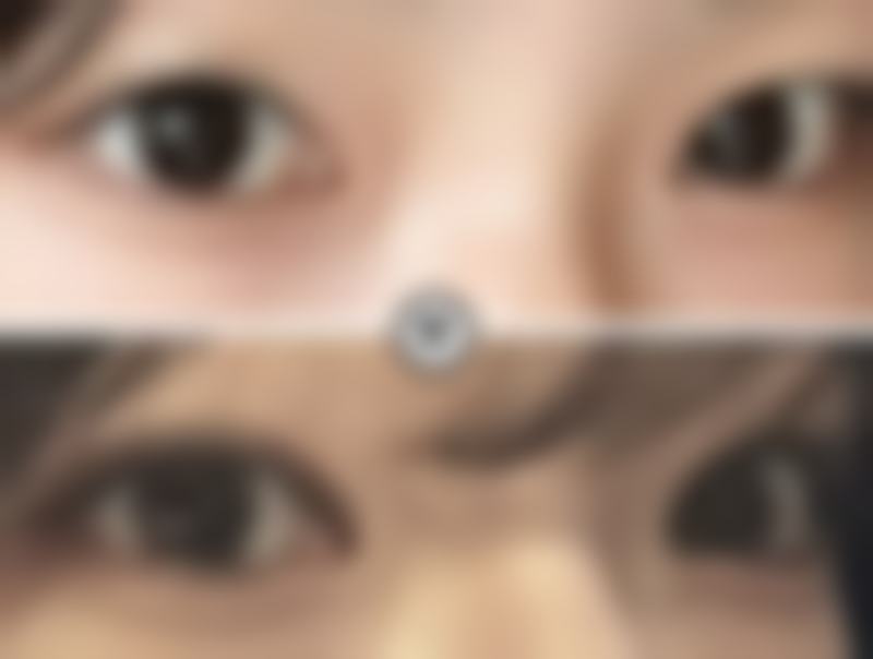 用自己的脂肪隆胸好吗总结