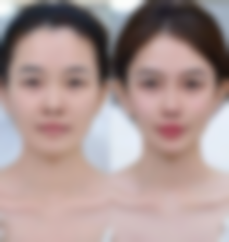 双眼皮割宽了修复手术过程是怎样的