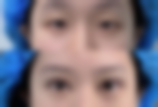 日常护理辅助去除缝针疤痕