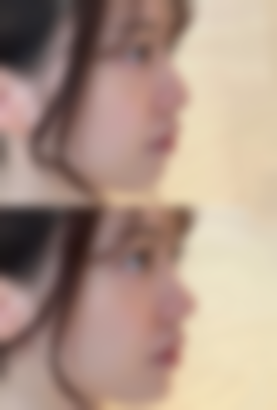 吸脂对孕期及产后修复的影响