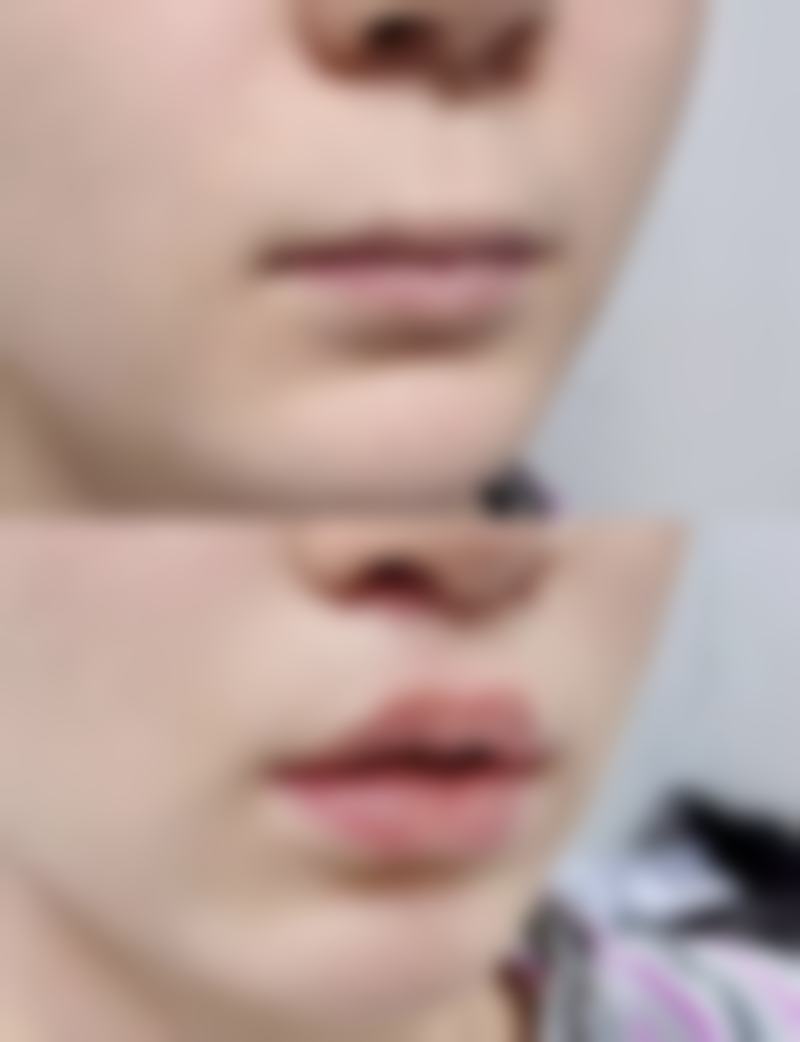 男人肚子大抽脂的风险和副作用有哪些