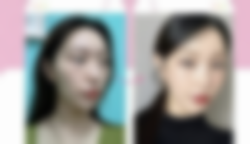 影响脂肪隆胸住院时间的因素