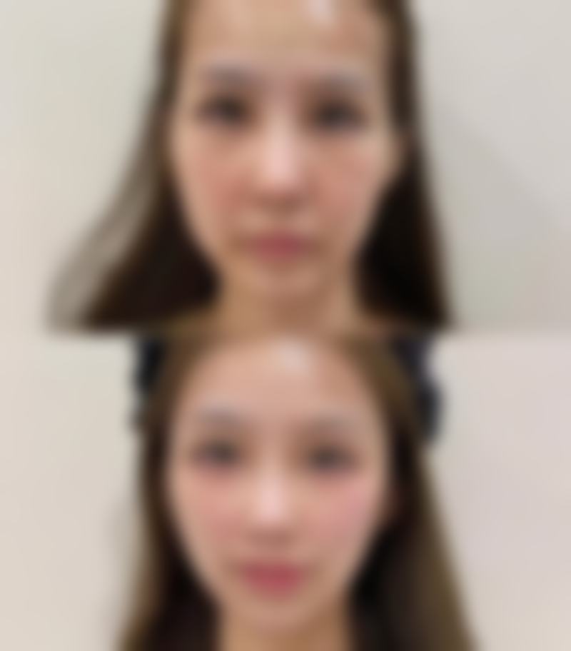 有名隆胸假体品牌特点