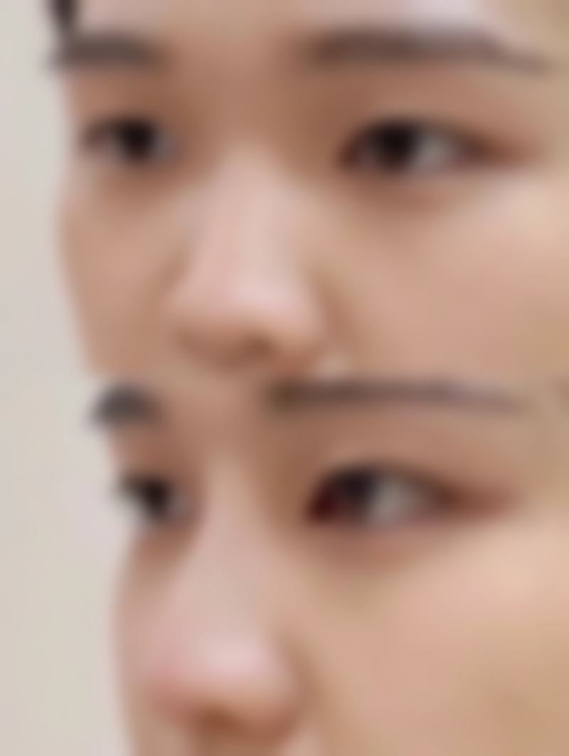 总结——佛山医博士整形美容医院邓勤焕医生怎么样？