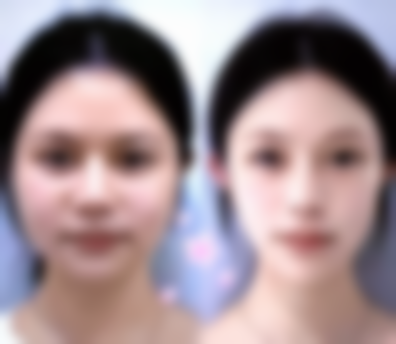 手臂吸脂的价格