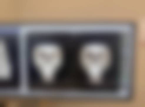 崔鑫医生经腹假体隆乳术介绍