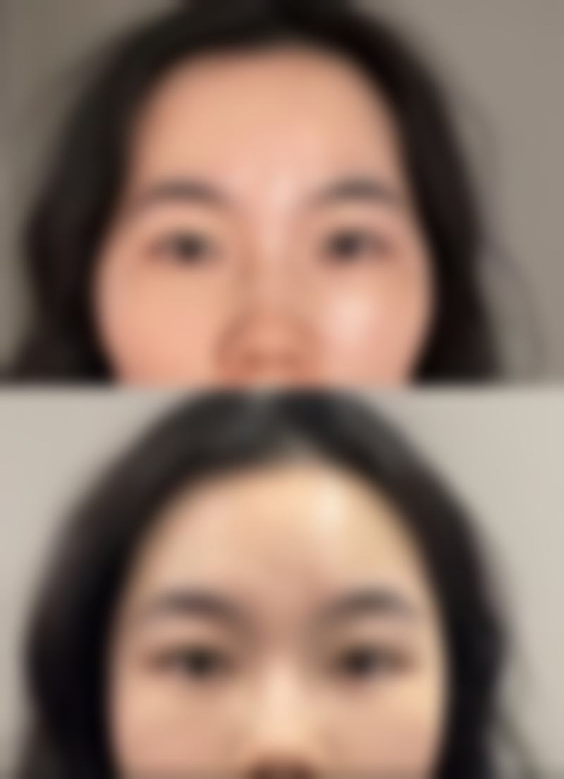 拆线后的护理要点