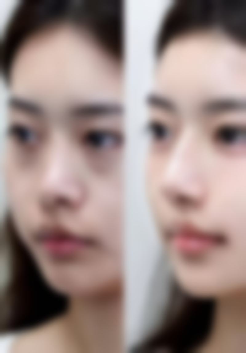 术后护理与长期维护