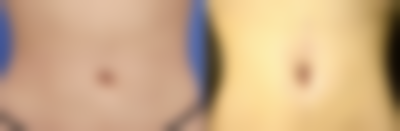 药物治疗去除疤痕