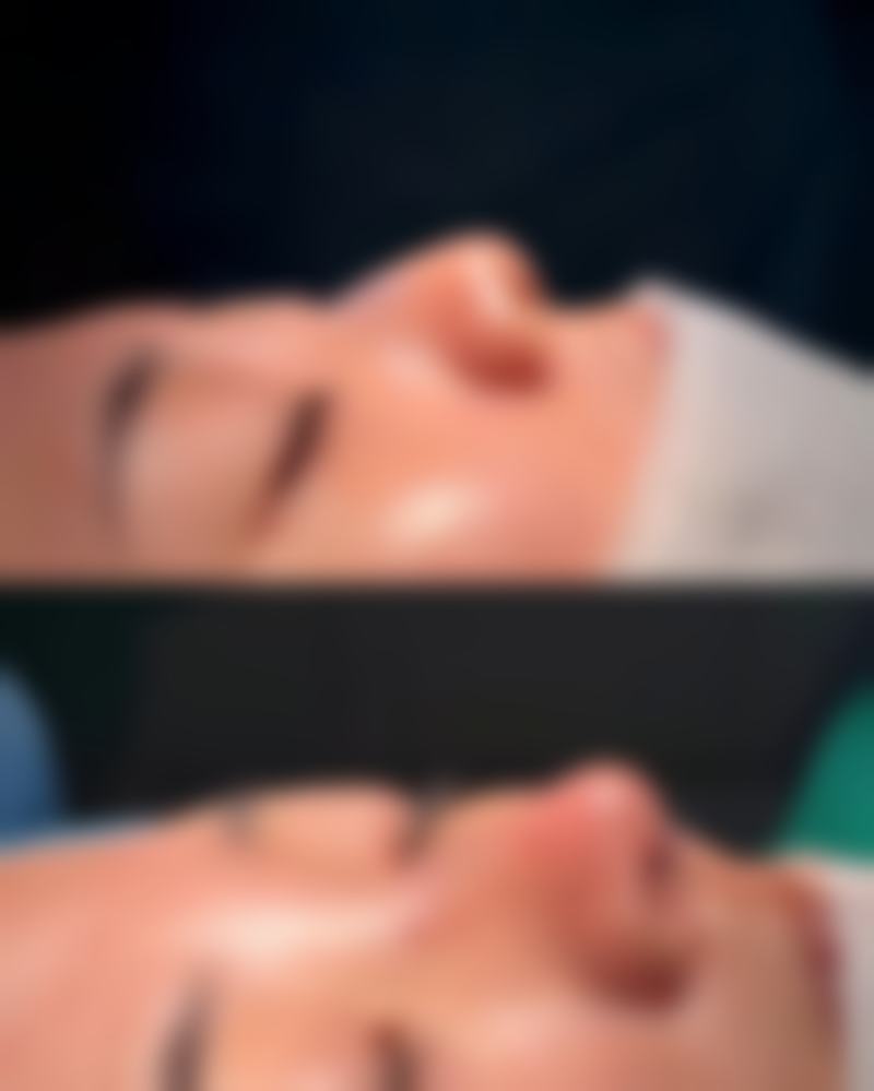 手术消除遗传眼袋的方法