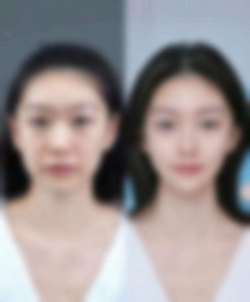 健康状况不佳的人不能割双眼皮