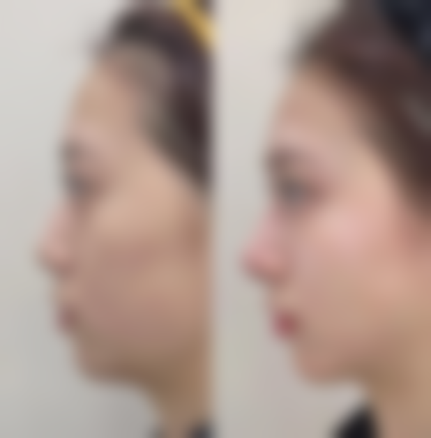 眼袋手术后的综合护理