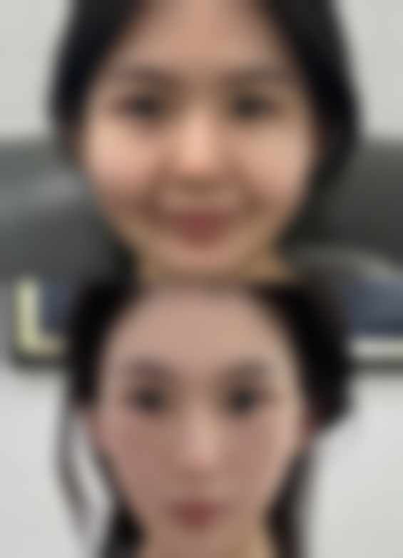 体位管理减轻眼部淤血